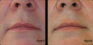 epilation_laser